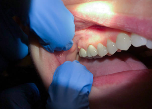 Best Tooth Infection Emergency Dentist  in Lake Fenton, MI