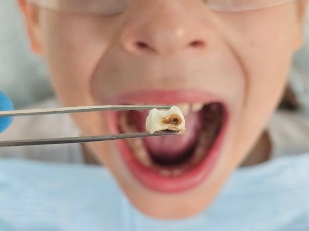Best Dentist for Tooth Abscess  in Lake Fenton, MI